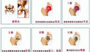 股骨頭壞死患者群（股骨頭壞死自我治愈群）